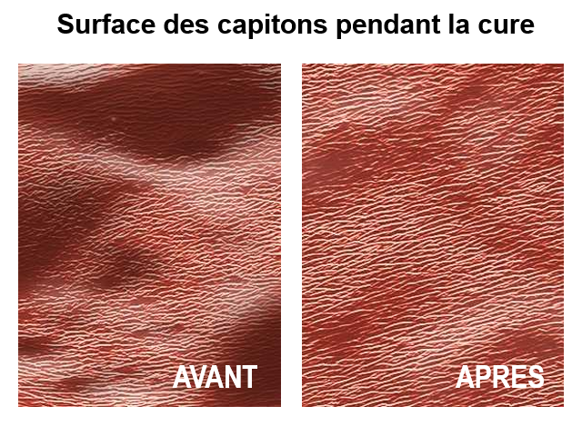 cure endermologie sur les capitons