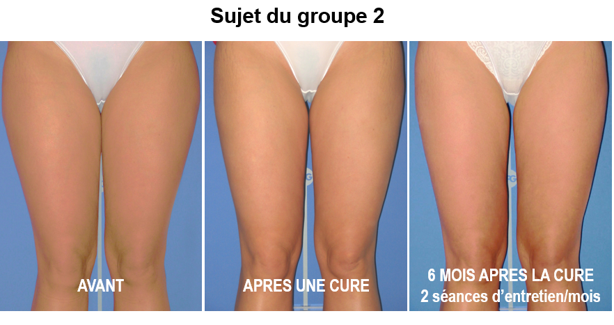cure endermologie résultats