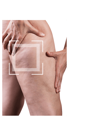 Zoom cellulite LPG