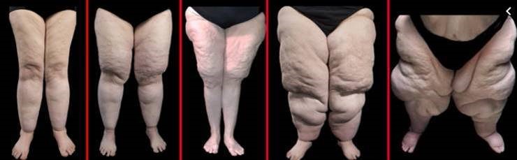 lipœdeme sur les jambes