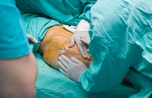 opération de liposuccion LPG