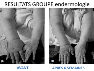 Image resultas groupe endermologie