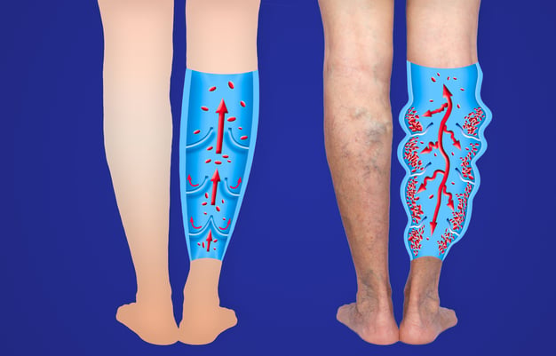 varices lpg endermologie