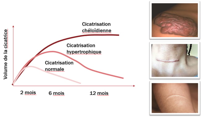 schéma volume dune cicatrice lpg médical