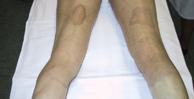sclerodermie