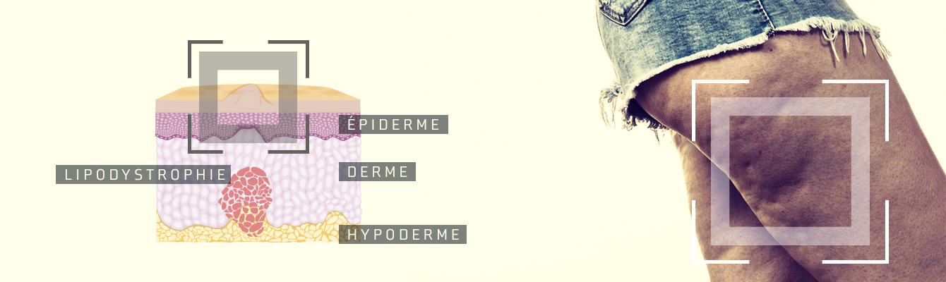 explication de la lipodystrophie