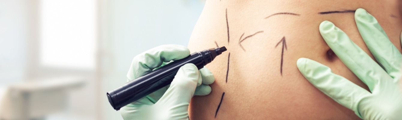 soin endermologie pour agir sur la liposuccion