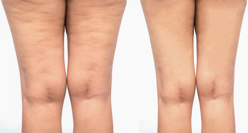 traitement-cellulite