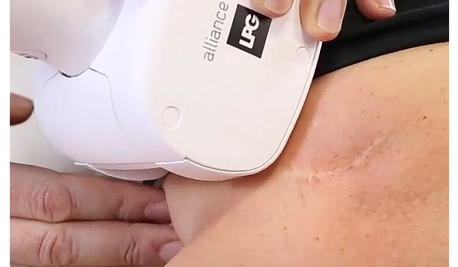 cellu M6® dans le traitement post masectomie
