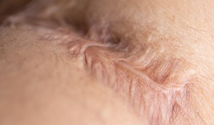 Traitement des défauts cutanés profonds par mécanotransduction