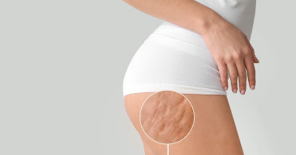 LPG dévoile son soin anti-cellulite, un protocole 3 en 1 aux multiples avantages qui permet de raffermir efficacement la peau.