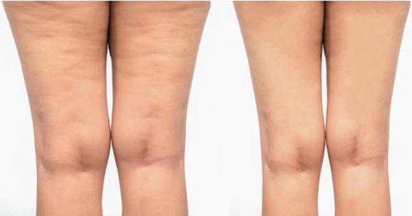 Le nouveau protocole Anti-Cellulite 3 en 1 de LPG est un traitement de 10 séances étalées sur 5 semaines permettant d’éliminer tous les types de cellulite.